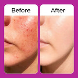Before and after comparison of skin with acne on a purple background