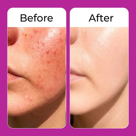 Before and after comparison of skin with acne on a purple background